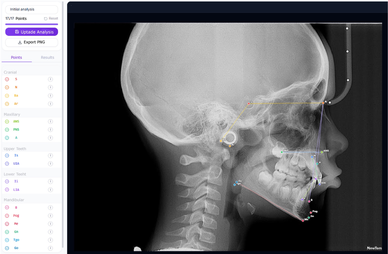 Analisi cefalometrica DentalFlow